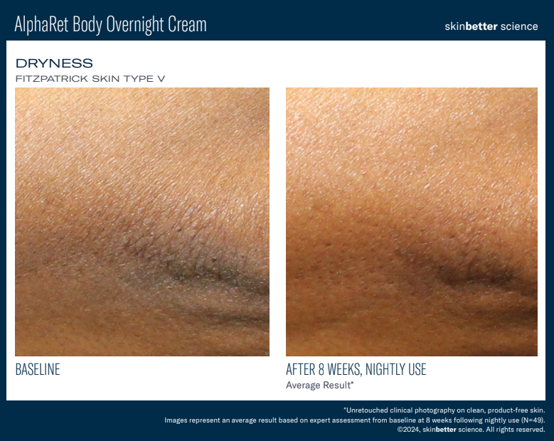AlphaRet BODY Overnight Cream