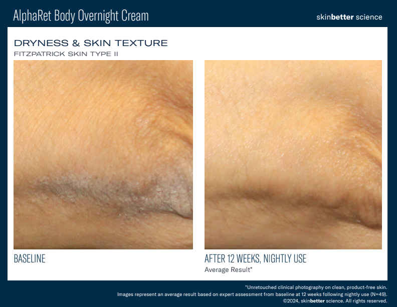 AlphaRet BODY Overnight Cream